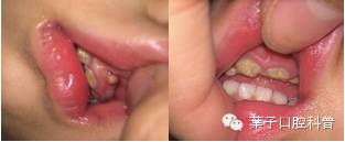 牙龈上长脓包是瘘管吗,牙龈上长脓包能用双氧水吗