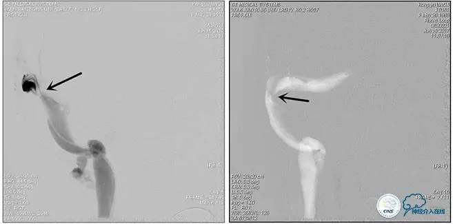 静脉窦狭窄支架植入术,静脉窦狭窄做支架多少钱