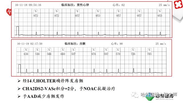 「心声」长程心电检测设备在房颤管理中的重要地位