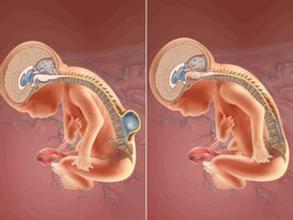 孩子脊柱裂有治疗办法吗,先天性脊柱裂有哪些症状