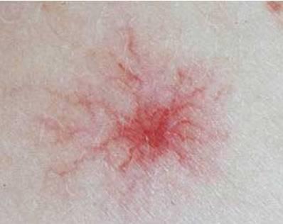 全身突然出现很多小红痣不痛不痒,身上突然长很多小红痣是什么原因