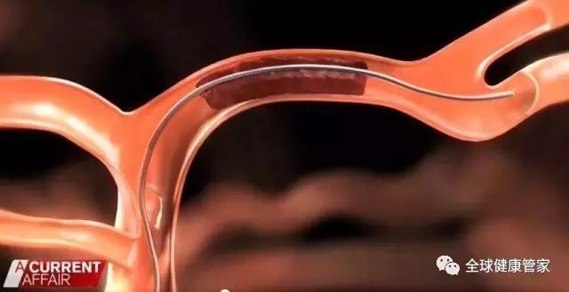 澳洲治疗中风可怕副作用,澳洲十大黑科技药