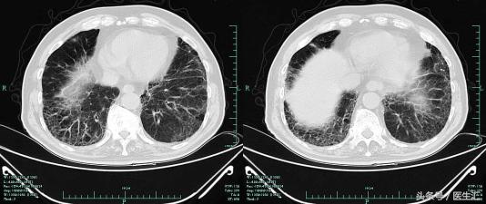 咳嗽胸闷反复发作久治不愈怎么办,反复咳嗽咳痰气促是什么病