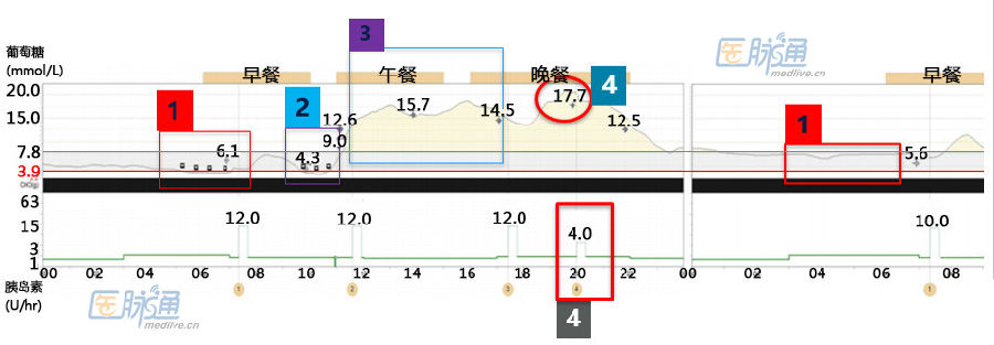 济南泉信｜怎样利用动态血糖监测仪调节胰岛素泵剂量？