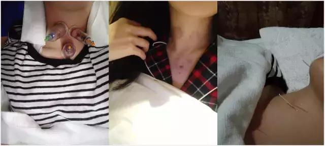 杨幂治掉头发防脱发,杨幂放血治感冒吗