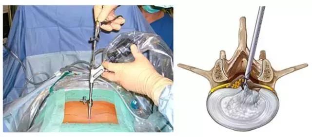 《1039生活馆》之“健康导医”：腰突手术如何不再“伤筋动骨”？