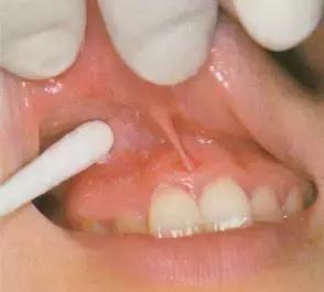 口腔麻醉方法,睡眠麻醉口腔