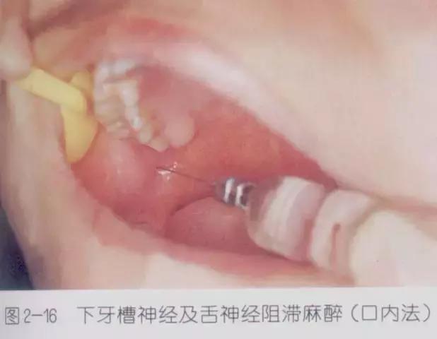 口腔麻醉方法,睡眠麻醉口腔