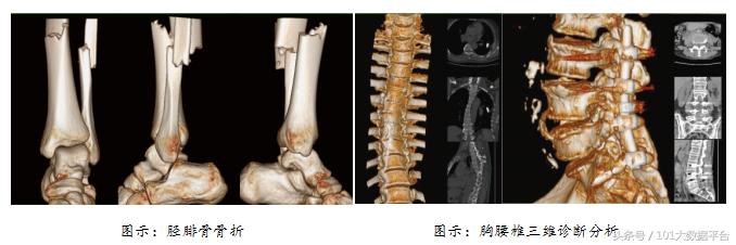 多模式VR重建+精准术前评估，博为三维重建成张家口市第二医院临床骨科精准诊疗的强大工具