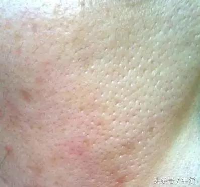 突然开始长痘该如何注意,40岁男人额头长痘什么原因引起