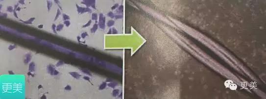 埋线美容线和不吸收线有什么区别,医院埋线和美容院埋线有什么差别