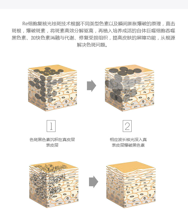 告别鹌鹑颜·美丽从此不一“斑”