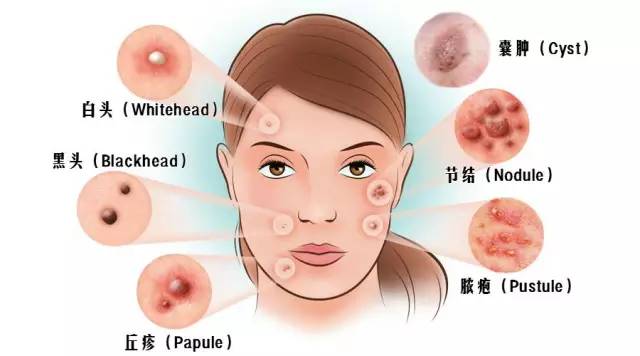 痘疮病怎么治疗,痘疮的中医辨证治疗