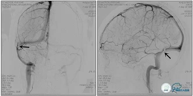 脑静脉窦狭窄做支架危险吗,静脉窦狭窄做支架后多久恢复