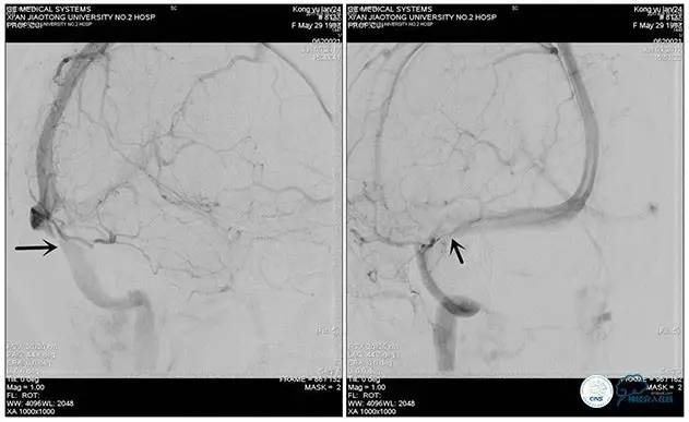 静脉窦狭窄支架植入术,静脉窦狭窄做支架多少钱