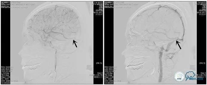 脑静脉窦狭窄做支架危险吗,静脉窦狭窄做支架后多久恢复