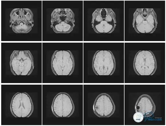 静脉窦狭窄支架植入术,静脉窦狭窄做支架多少钱