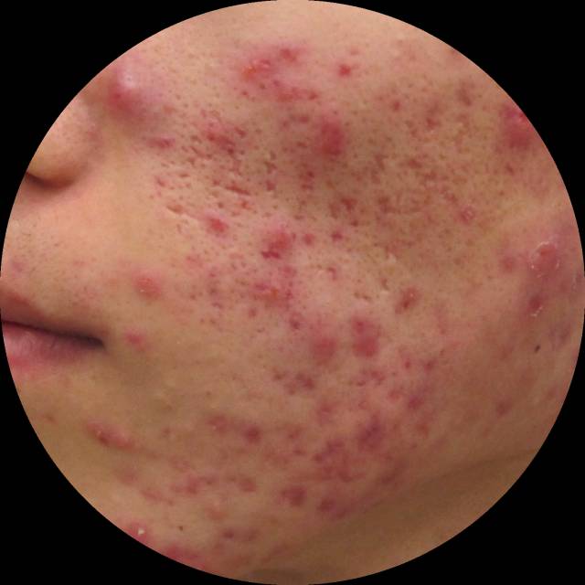 十年战痘血泪史详解,战痘知识分享