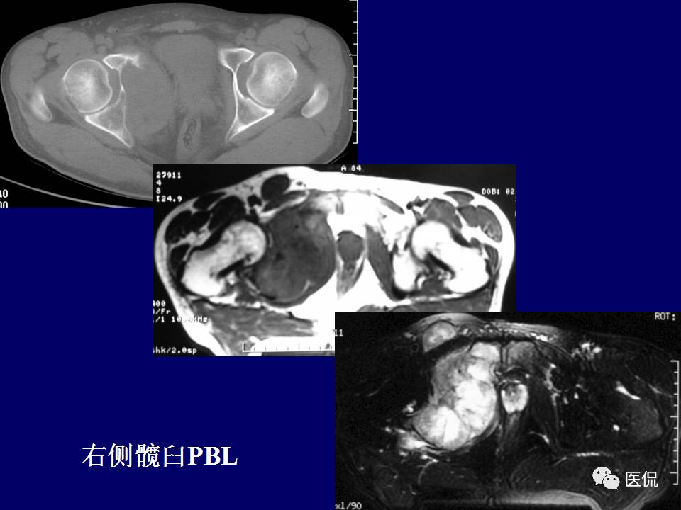 徐文坚老师精讲：原发性骨淋巴瘤影像学诊断医学影像精品PPT