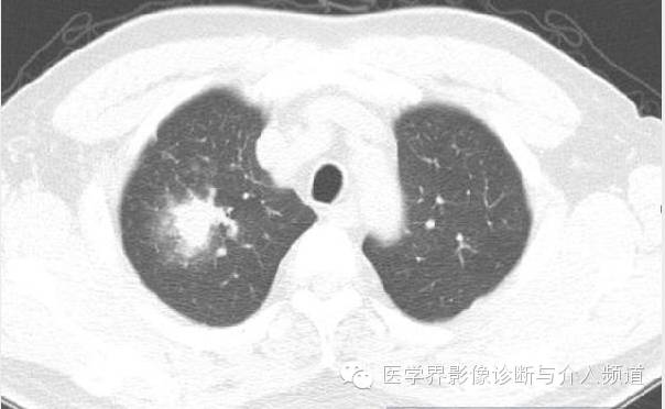 咳嗽排除了肺部的问题,咳嗽为什么比不咳好