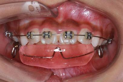 龅牙地包天怎么弄,龅牙怎么解决最好