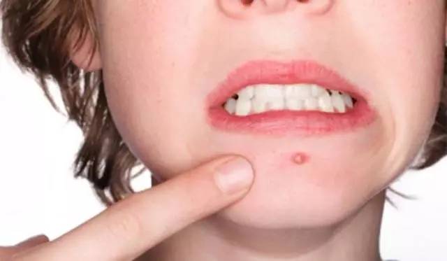 十年战痘血泪史详解,战痘知识分享