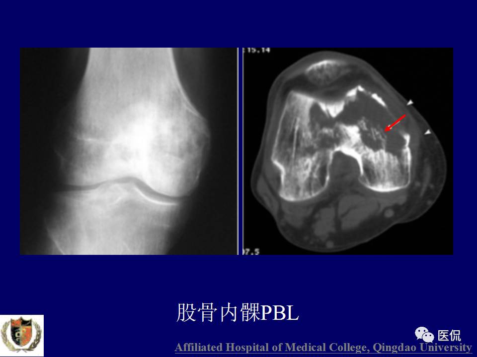 徐文坚老师精讲：原发性骨淋巴瘤影像学诊断医学影像精品PPT