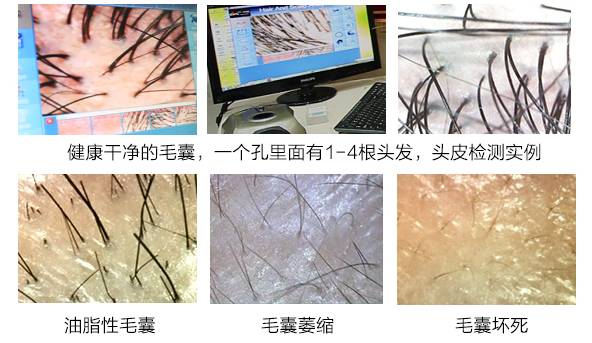 严重脱发秃顶发际线后移如何改善,长期熬夜导致发际线后移秃顶脱发