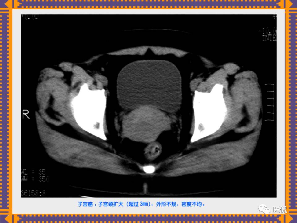 生殖系统疾病影像学诊断医学影像精品PPT