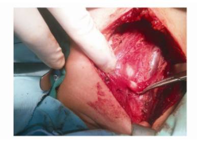 甲状腺乳头状癌消融治疗后再手术策略