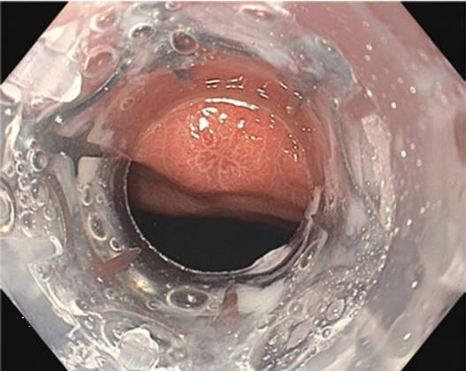 内镜下肌切开术手术步骤,肌肉活检最新技术