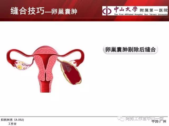 妇科腹腔镜下常用缝合技巧