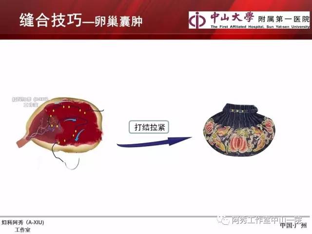 妇科腹腔镜下常用缝合技巧