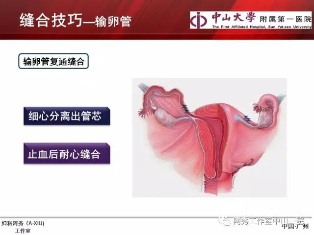 妇科腹腔镜下常用缝合技巧