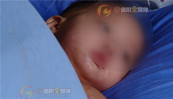 19岁烧伤女孩小玲出院啦,烧伤女孩小玲最新消息