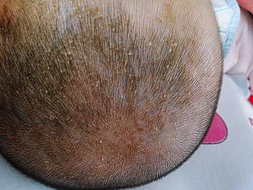专家在线丨宝宝头上有乳痂抠掉就好了？你的处理方式可能会伤了孩子的头皮！