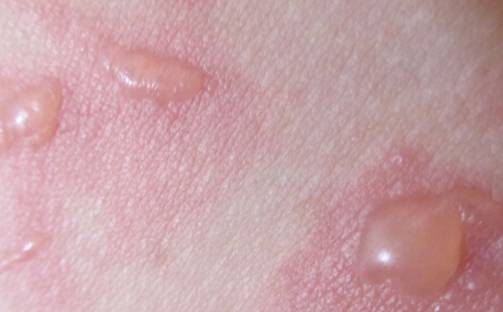 90度开水大面积烫伤急救,儿童开水烫伤急救处理