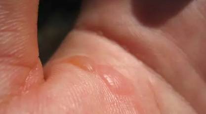 90度开水大面积烫伤急救,儿童开水烫伤急救处理