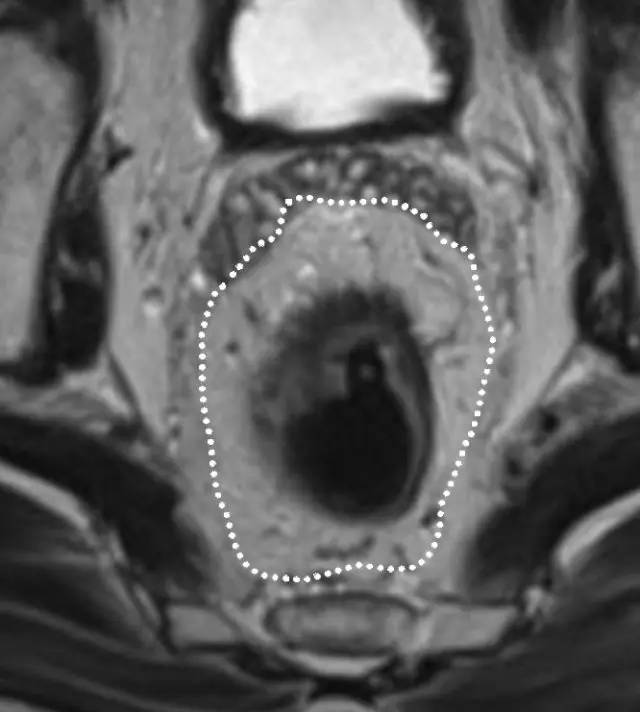 记住一个单词的一般方法,记住癌症九字诀