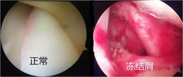 吓人！她肩膀居然破了个“洞”，只因天天做这个动作……黔南人赶紧自查看看！