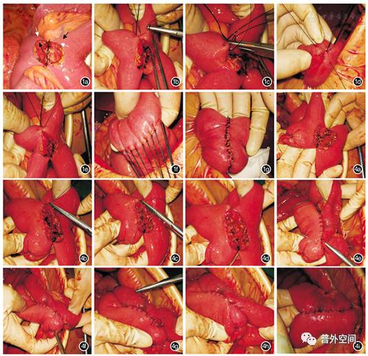 褥式垂直缝合法,垂直褥式缝合教学视频