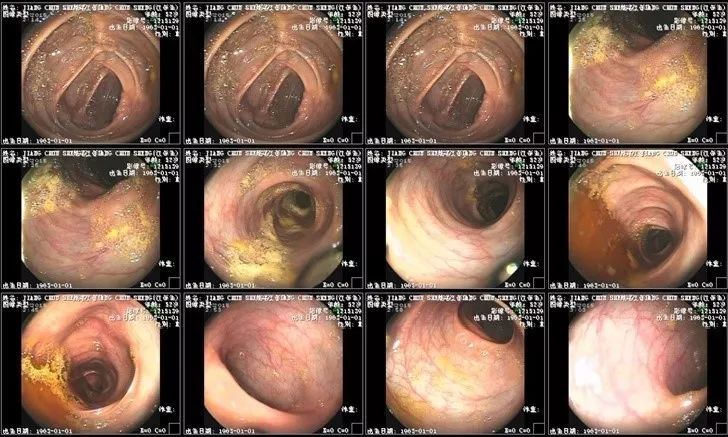 所有检查做完了不知道腹水原因,出现腹水是不是就是晚期了