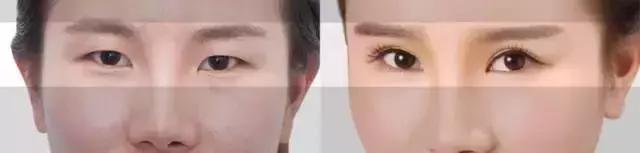 北京医院割双眼皮怎么样,北京三甲医院割双眼皮医生推荐