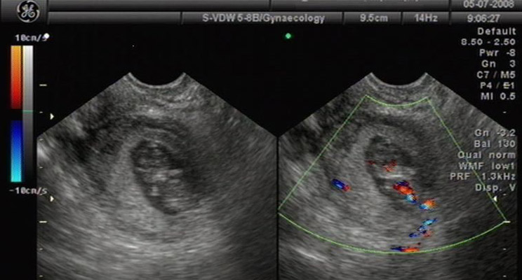 宫外孕知识100条,宫外孕知识大全集