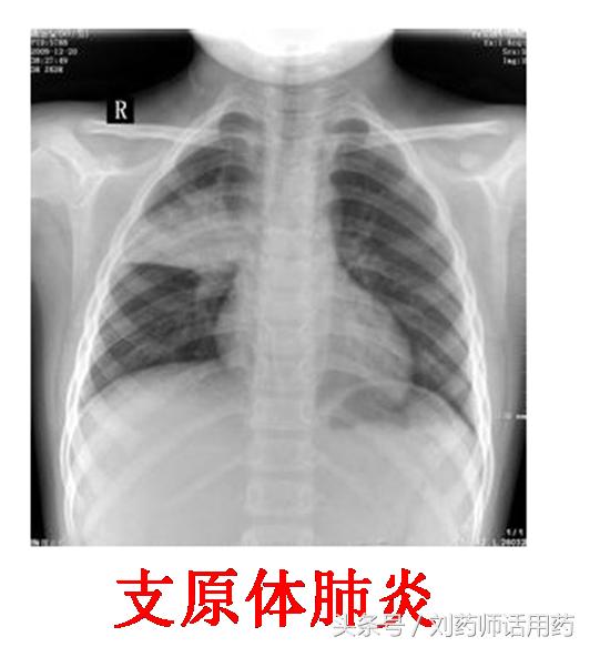 儿童支原体肺炎治疗需要几个疗程,支原体肺炎停用阿奇一天就烧