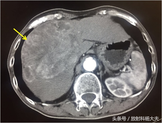 体检afp偏高10.65,体检afp甲胎蛋白偏高