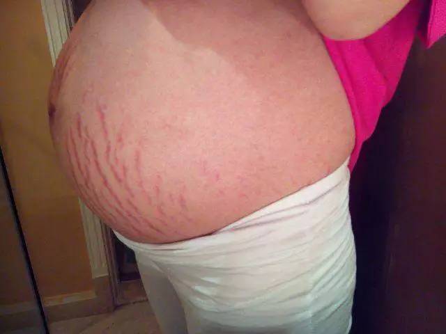 六大方法有效去除妊娠纹!收藏了!