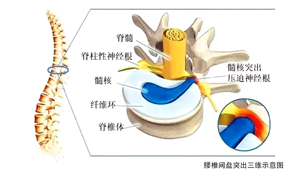 腰椎间盘脱落保守治疗成功率高吗,中央型腰椎间盘突出保守能治愈吗