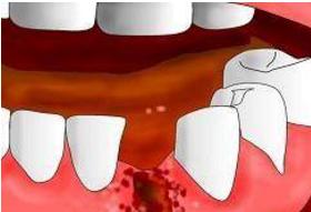 拔智齿拆线后吐口水有血色,拔智齿后吐不了棉球怎么办