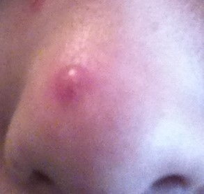 鼻子上挤出的白色分泌物怎么消除,鼻子两侧每天都能挤出白色的东西